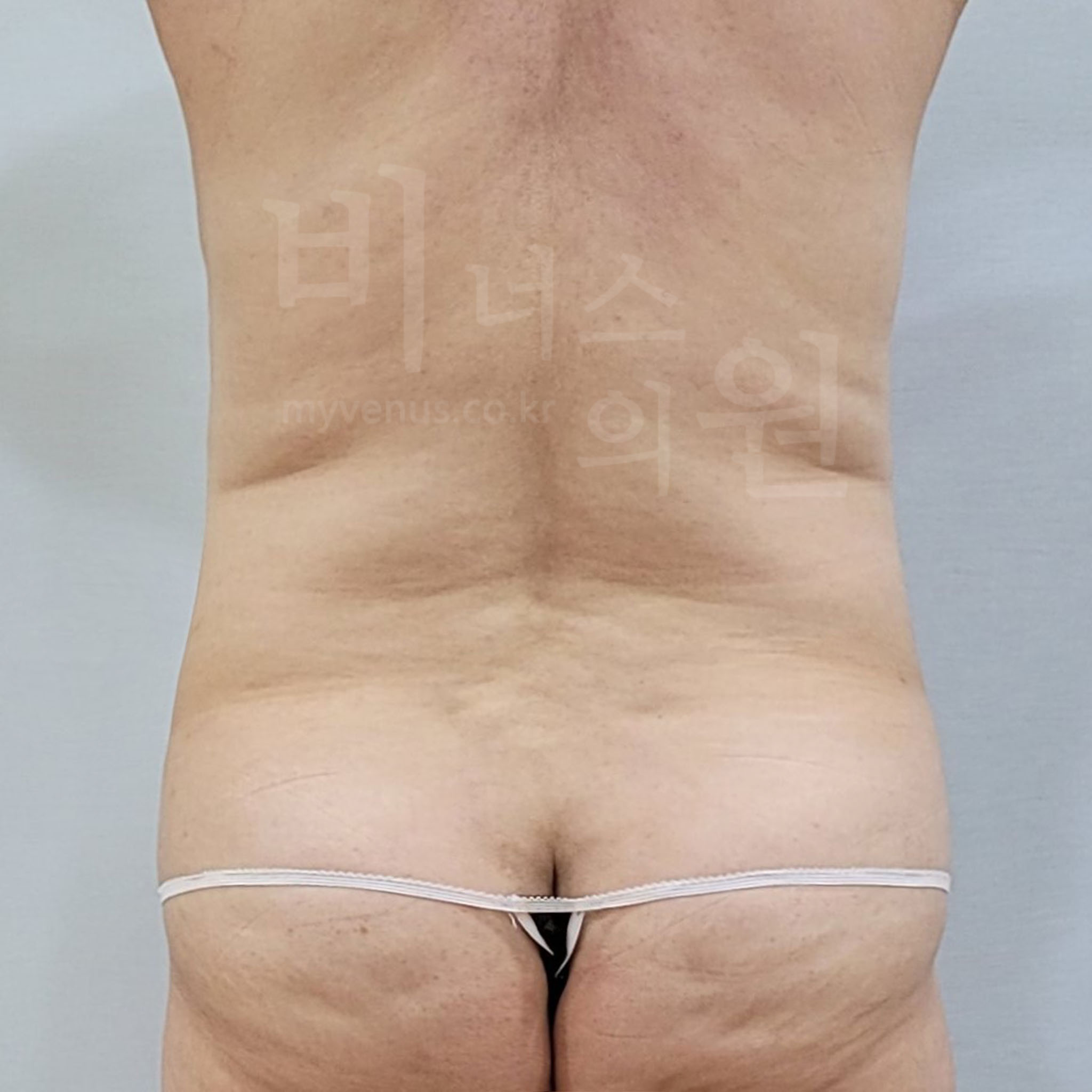 복부 지방흡입 수술 후 후면 사진