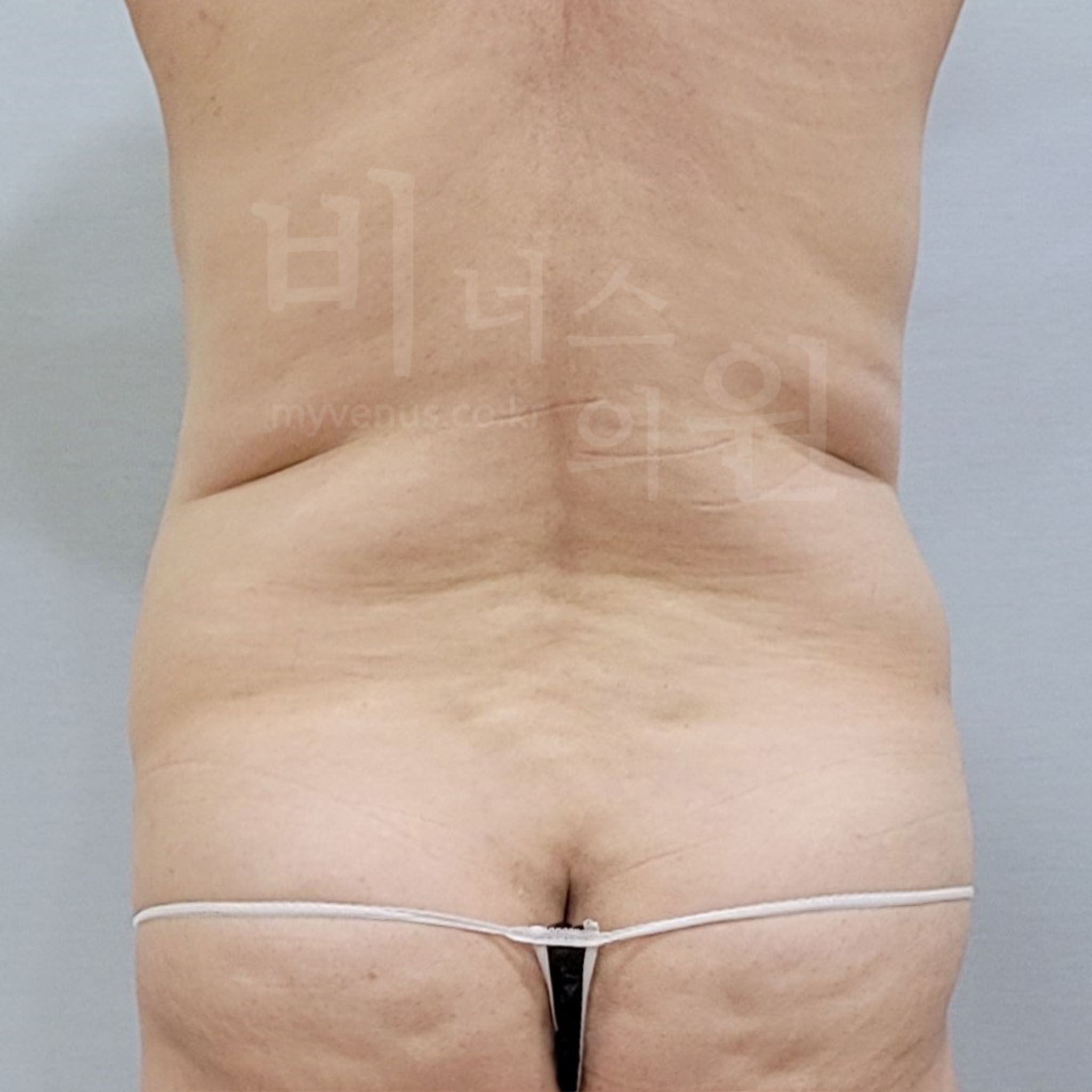 복부 지방흡입 수술 전 후면 사진