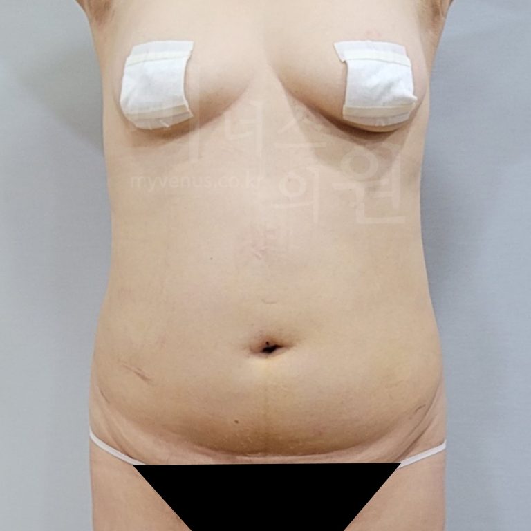 뱃살지방흡입 회복, 수술 당일부터 어떤 순서로 진행될까요
