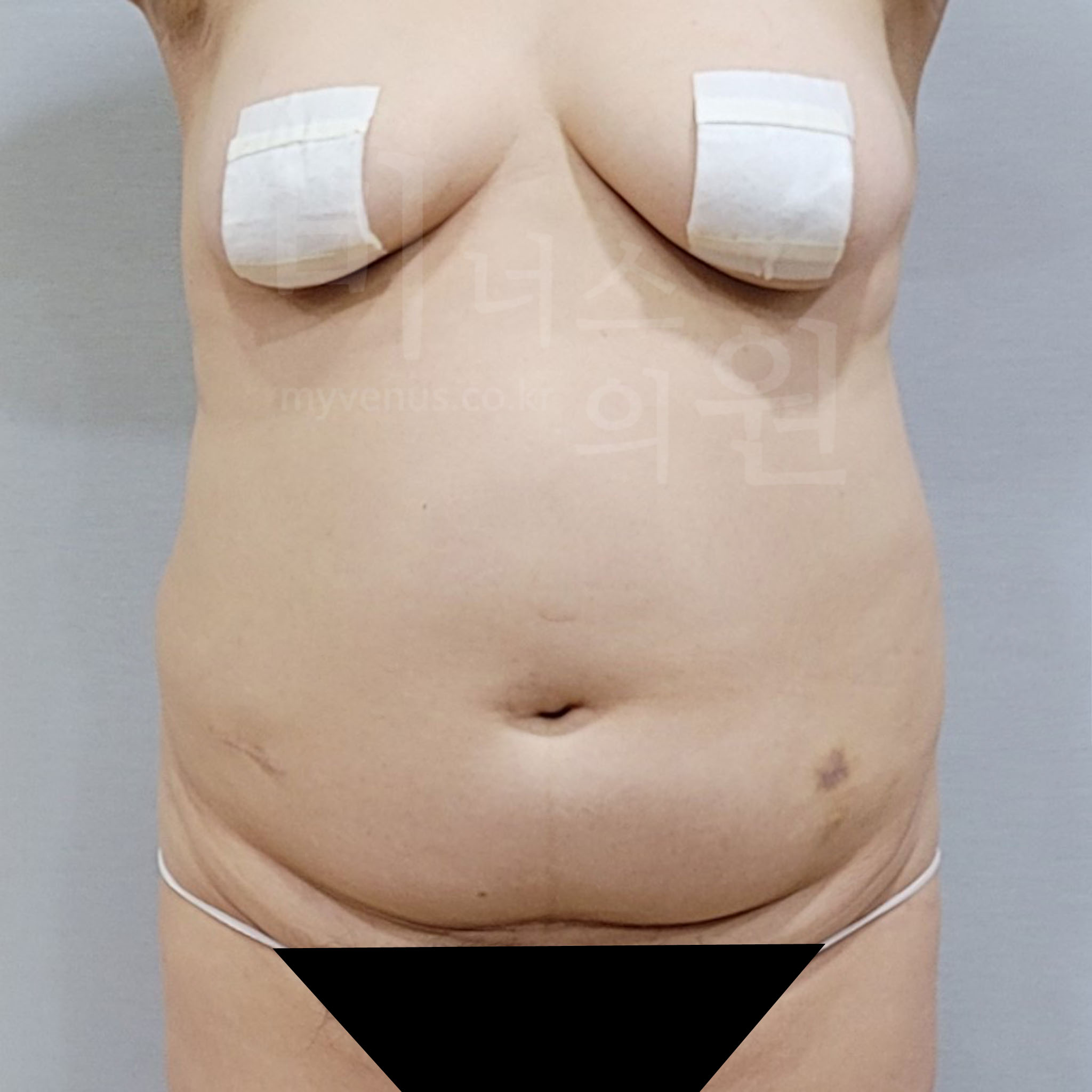복부 지방흡입 수술 전 정면 사진