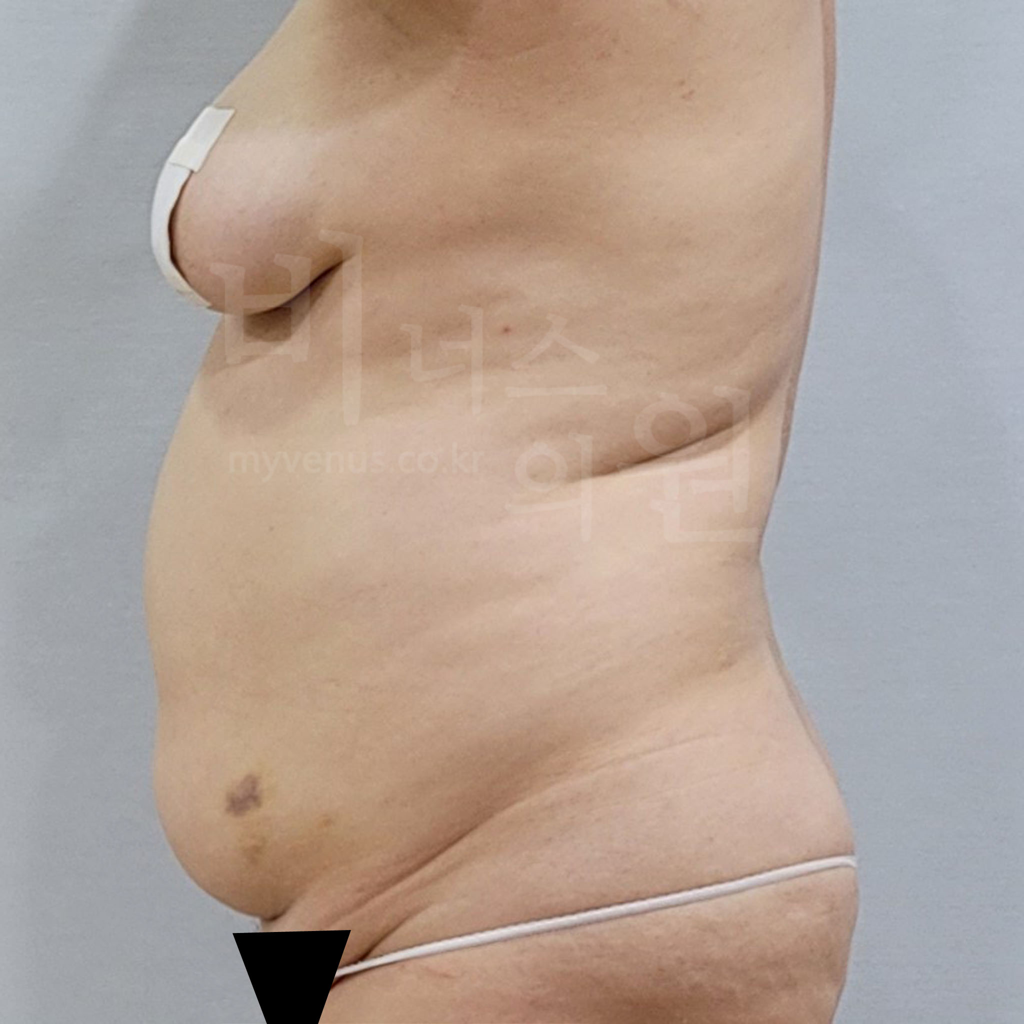 복부 지방흡입 수술 전 측면 사진