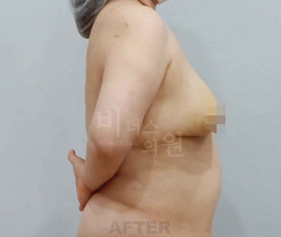 유방하수 지방흡입 수술 후 측면 사진
