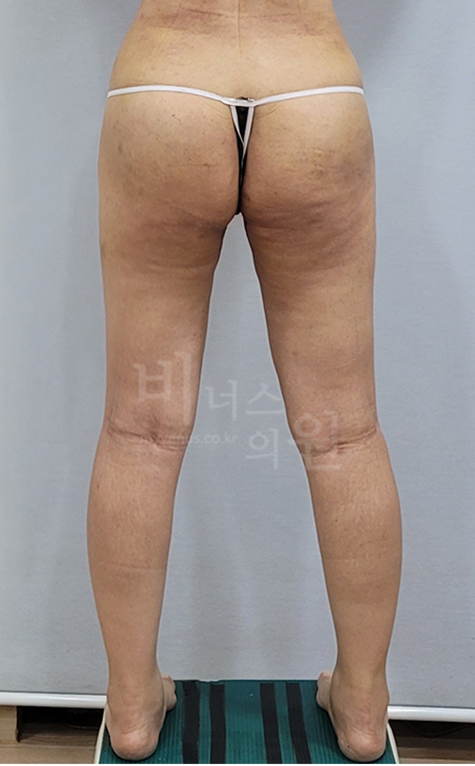 엉덩이 지방흡입·지방이식 후면 수술 후