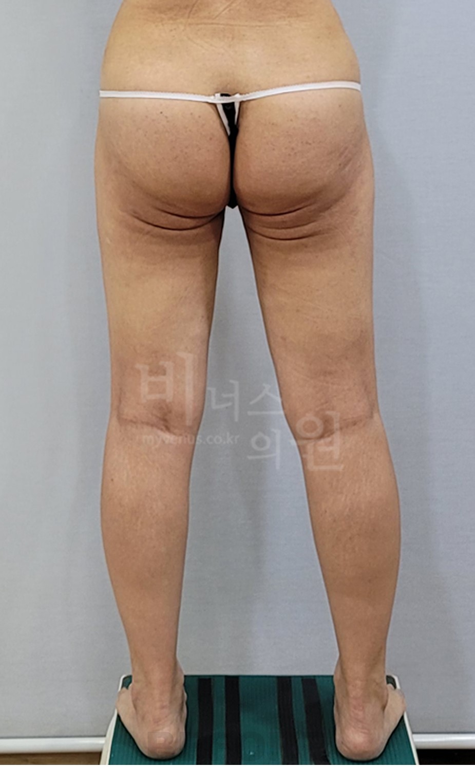 엉덩이 지방흡입·지방이식 후면 수술 전