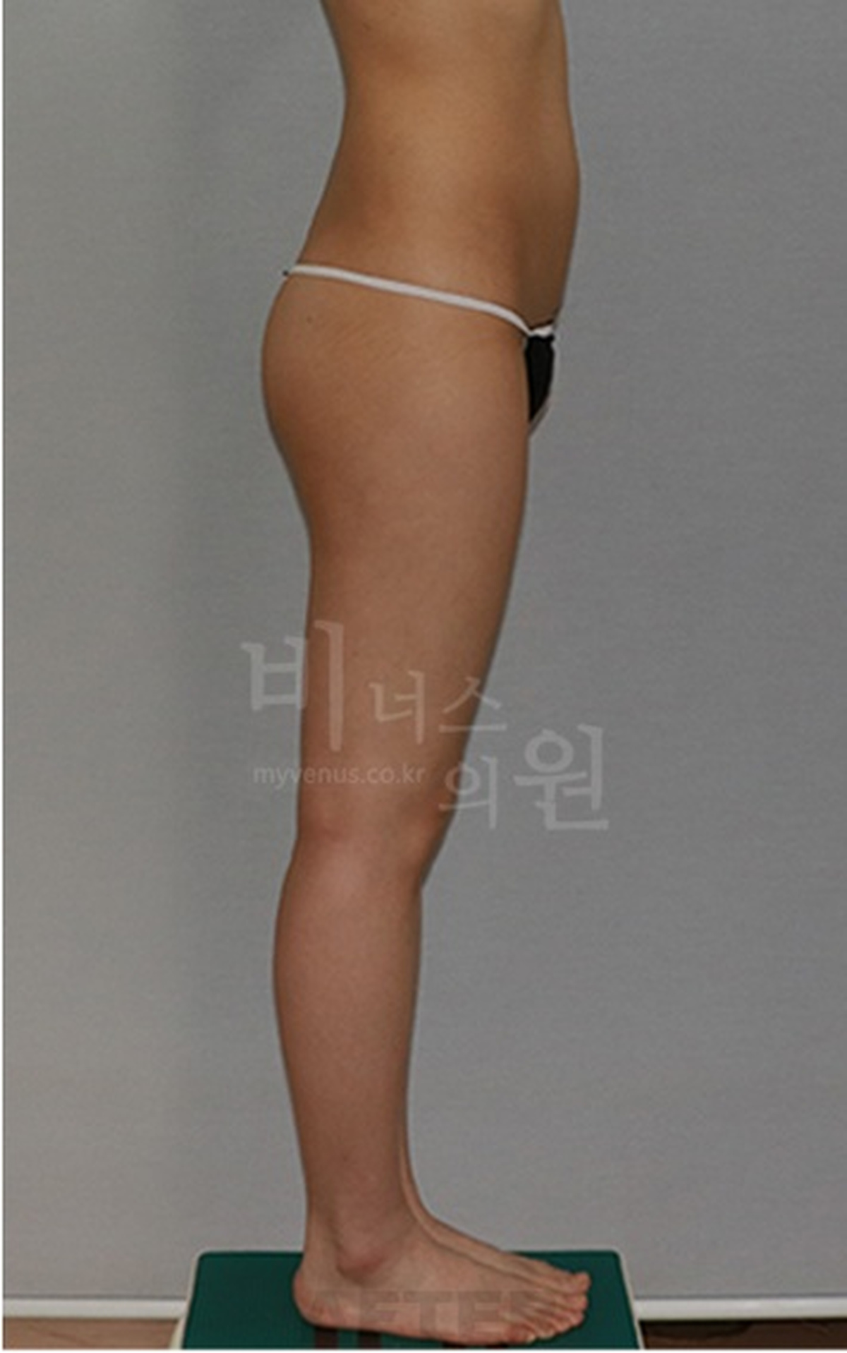 엉덩이 지방흡입·지방이식 측면 수술 후