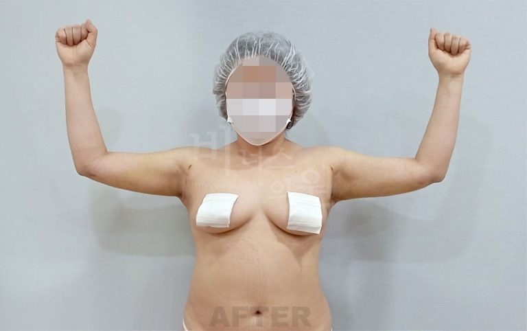 팔뚝 지방흡입 정면 팔 든 자세 수술 후