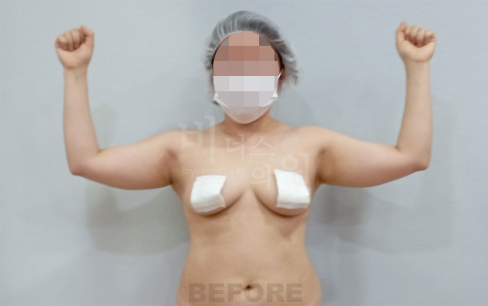 팔뚝 지방흡입 정면 팔 든 자세 수술 전