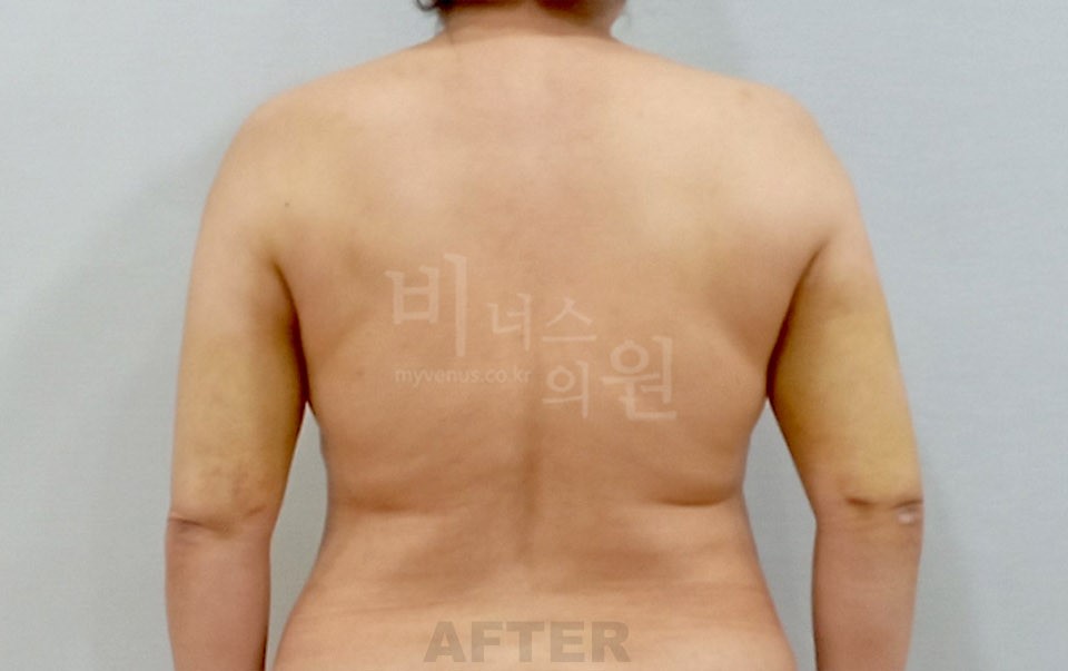 팔뚝 지방흡입 후면 팔 내린 자세 수술 후