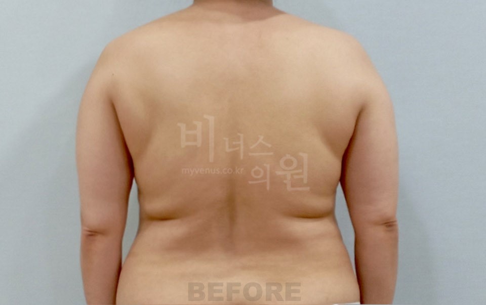 팔뚝 지방흡입 후면 팔 내린 자세 수술 전