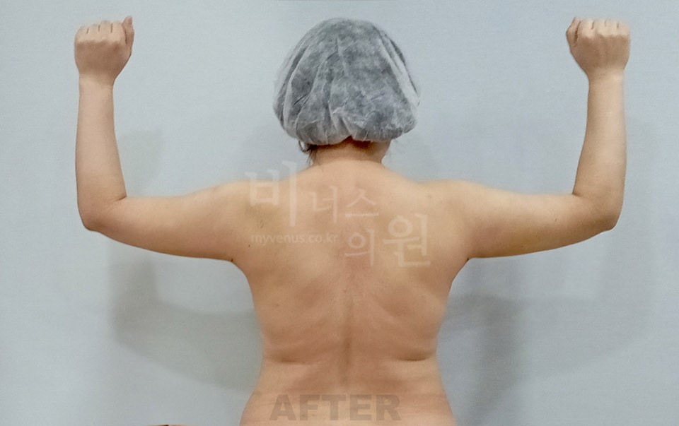 팔뚝 지방흡입 후면 팔 든 자세 수술 후