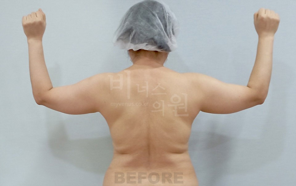 팔뚝 지방흡입 후면 팔 든 자세 수술 전
