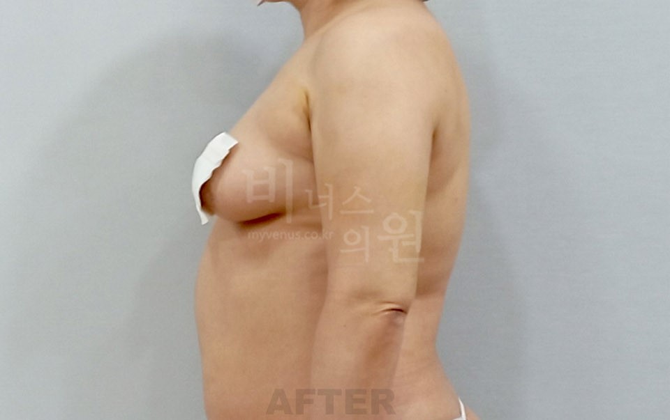 팔뚝 지방흡입 측면 팔 내린 자세 수술 후