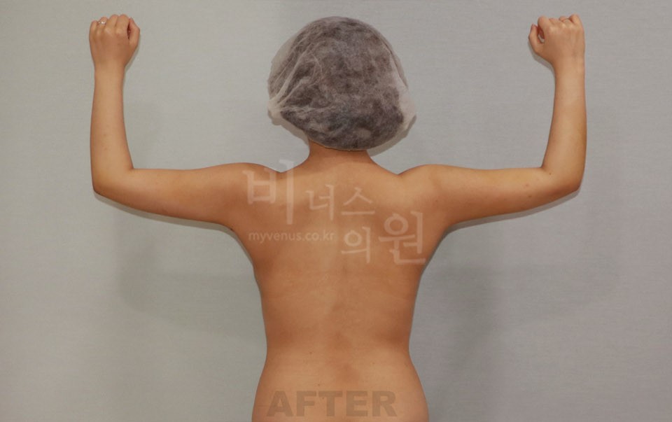팔 지방흡입 수술 후 후면, 양팔을 위로 올린 자세 사진