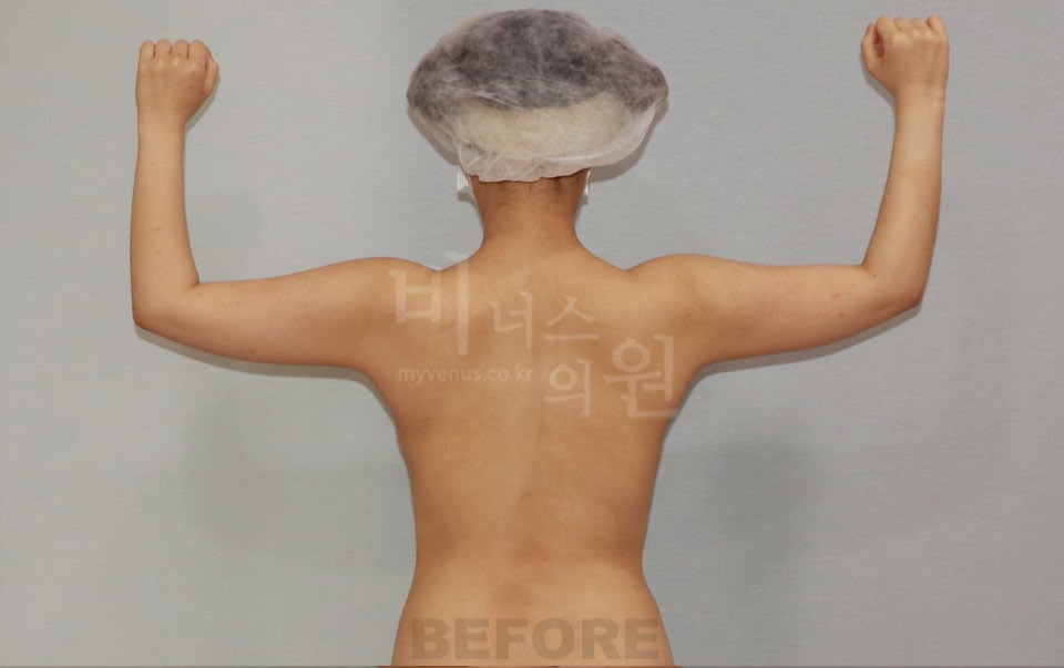 팔 지방흡입 수술 전 후면, 양팔을 위로 올린 자세 사진