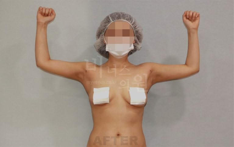 팔 지방흡입 수술 후 정면, 양팔을 위로 올린 자세 사진