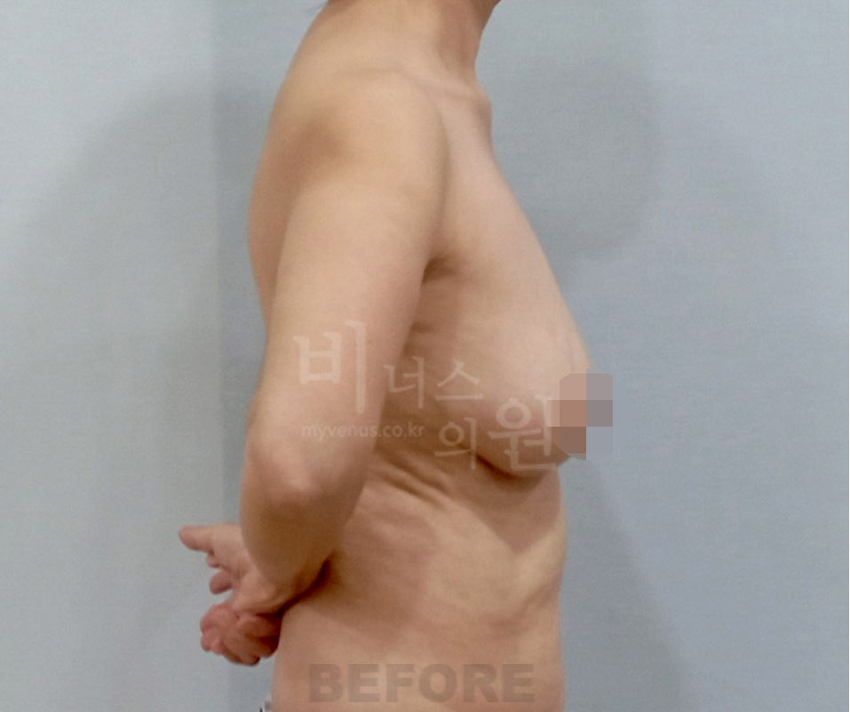 유방하수 표층 지방흡입 수술 전 측면 사진 — 유방 아랫부분이 아래로 늘어진 모습