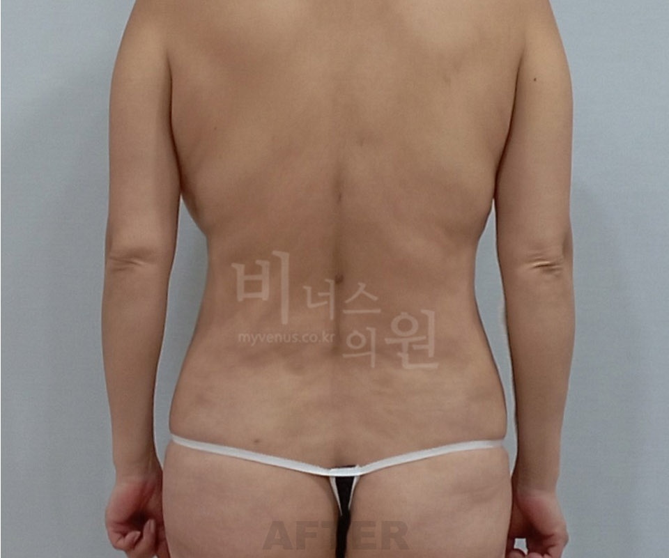 복부 지방흡입 후 후면 사진, 팔을 내린 자세에서 허리와 옆구리 윤곽