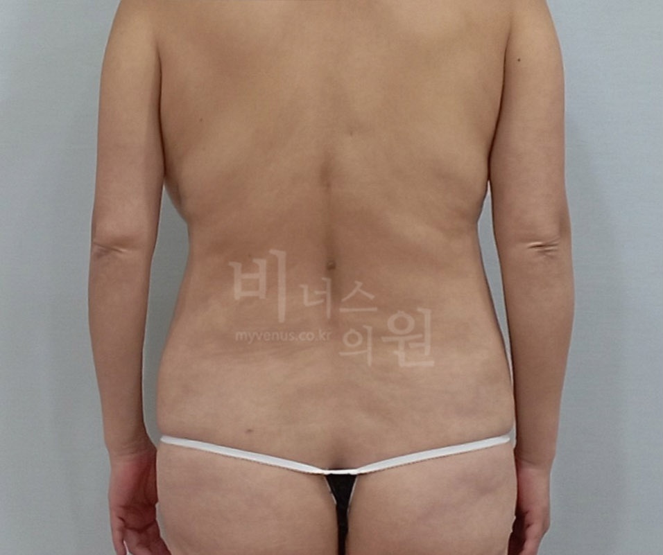 복부 지방흡입 전 후면 사진, 팔을 내린 자세에서 허리와 옆구리 윤곽