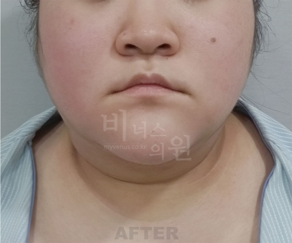 이중턱·턱라인 정면 수술 후 — 2025년 촬영