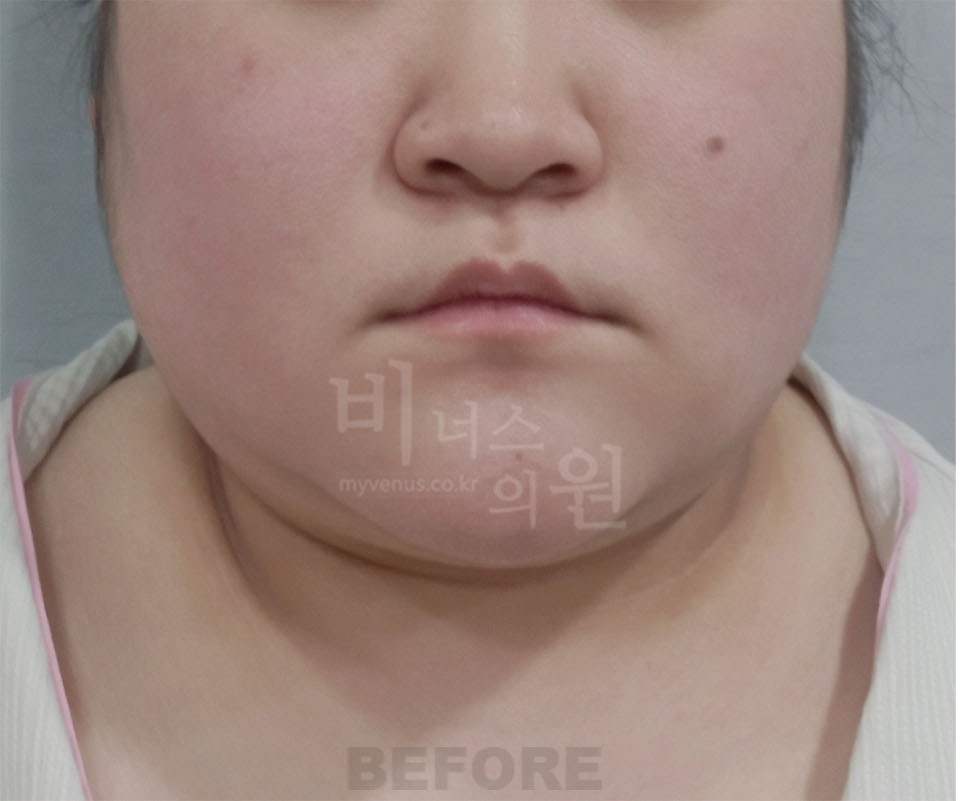 이중턱·턱라인 정면 수술 전 — 2025년 촬영
