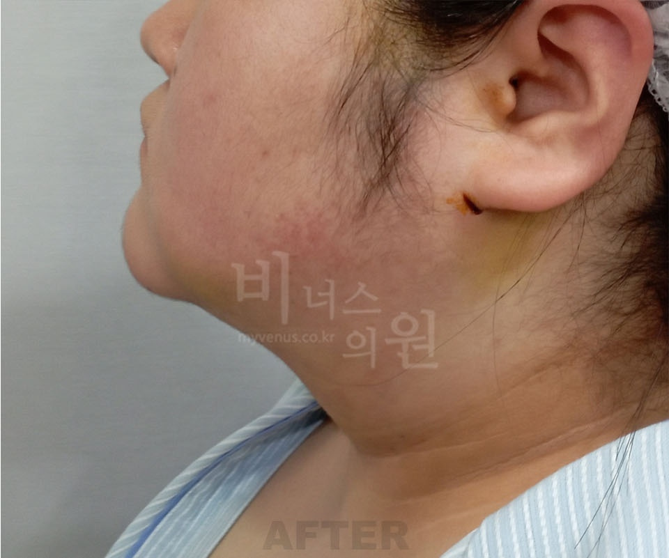 이중턱·턱라인 측면(화면 왼쪽 방향) 수술 후 — 2025년 촬영
