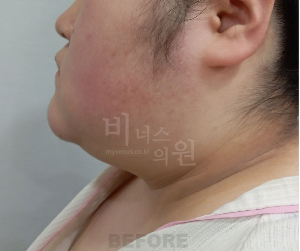 이중턱·턱라인 측면(화면 왼쪽 방향) 수술 전 — 2025년 촬영