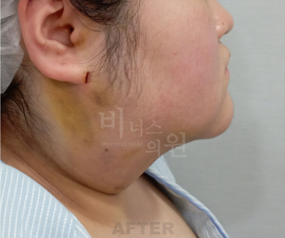 이중턱·턱라인 측면(화면 오른쪽 방향) 수술 후 — 2025년 촬영