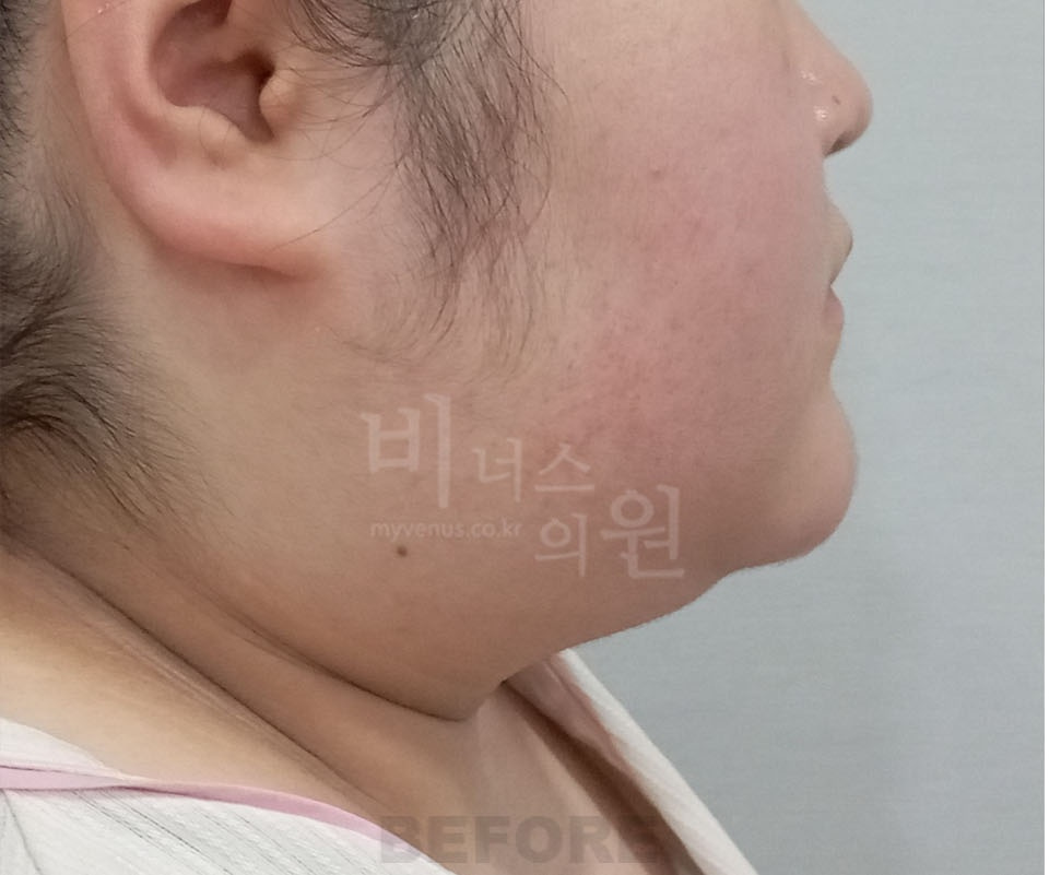 이중턱·턱라인 측면(화면 오른쪽 방향) 수술 전 — 2025년 촬영