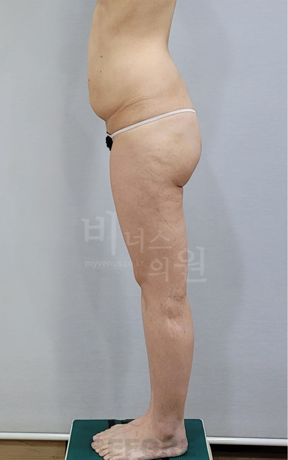 엉덩이 지방흡입 좌측면 수술 전 — 2026년 촬영
