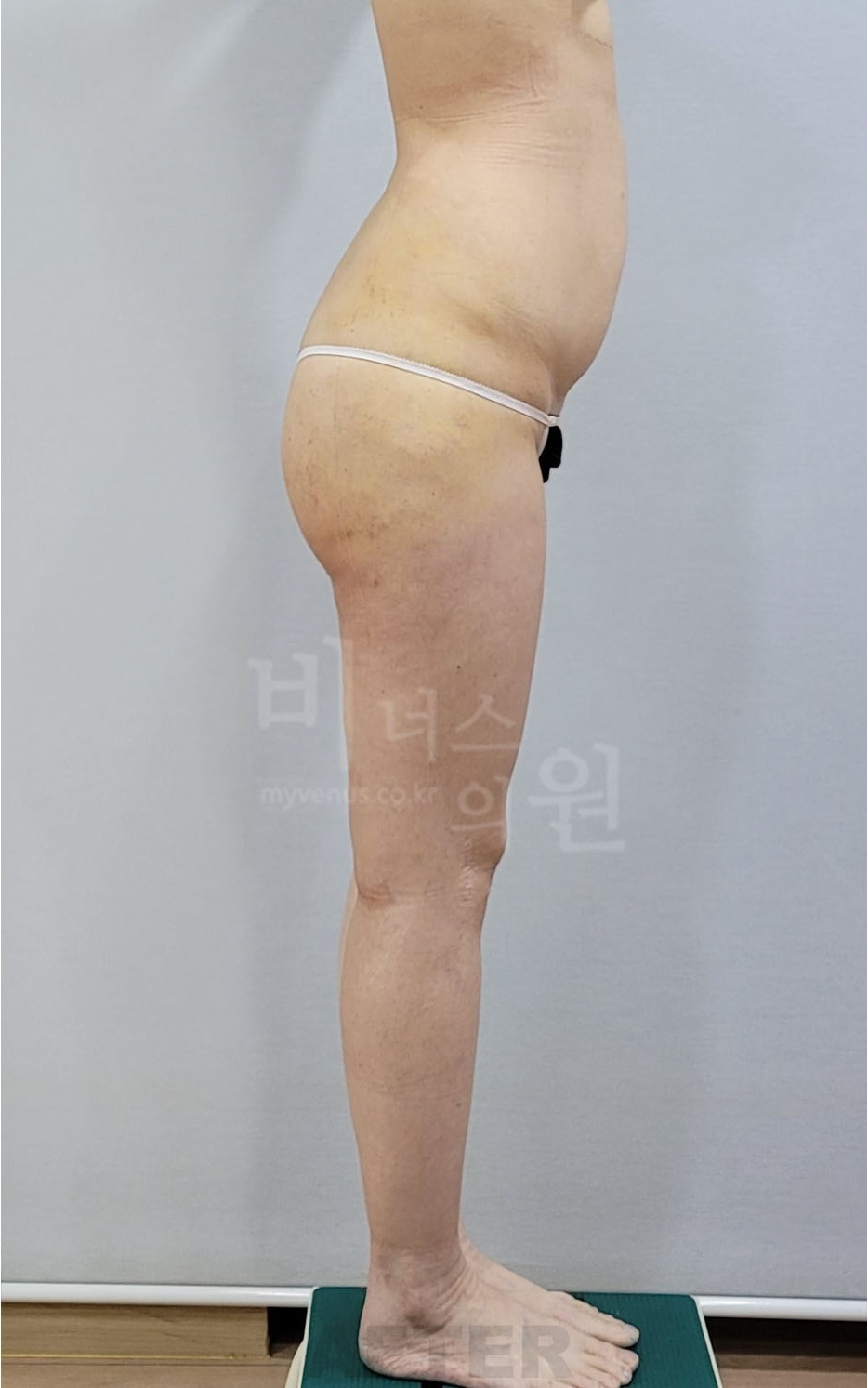 엉덩이 지방흡입 우측면 수술 후 — 2026년 촬영