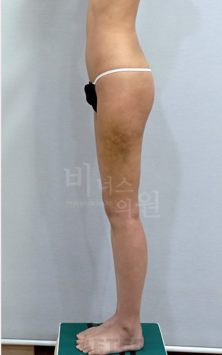 허벅지 지방흡입 측면 수술 후 (2025년 촬영)