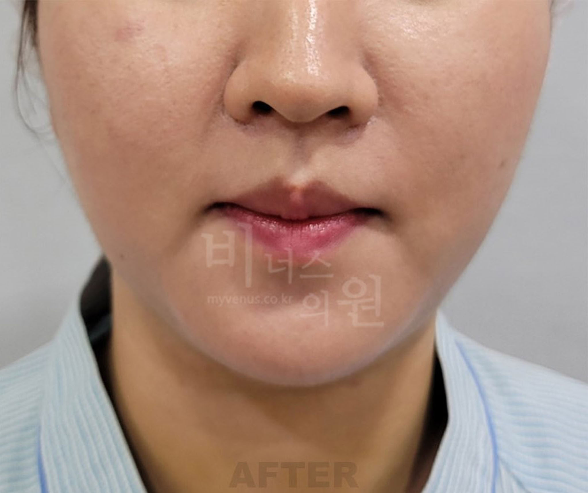 이중턱·턱라인 지방흡입 수술 후 정면 (2025년 촬영)
