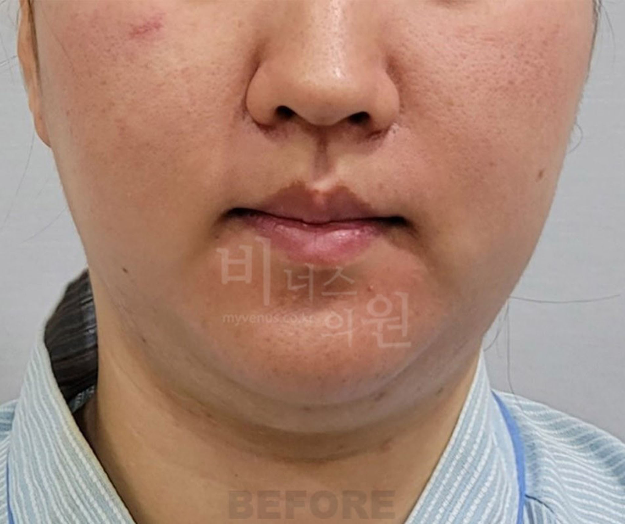 이중턱·턱라인 지방흡입 수술 전 정면 (2025년 촬영)