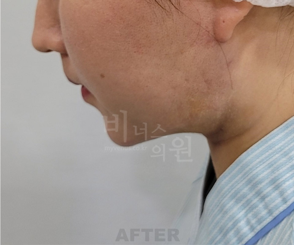 이중턱·턱라인 지방흡입 수술 후 측면① (2025년 촬영)