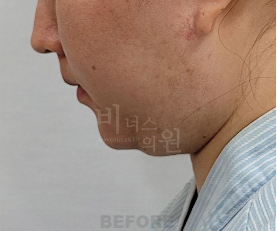이중턱·턱라인 지방흡입 수술 전 측면① (2025년 촬영)