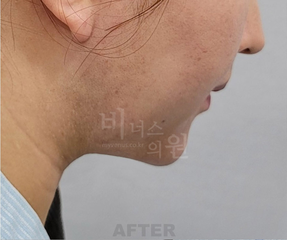 이중턱·턱라인 지방흡입 수술 후 측면② (2025년 촬영)