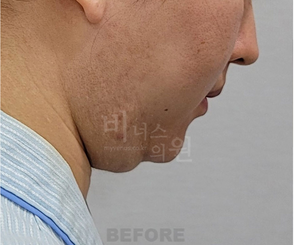 이중턱·턱라인 지방흡입 수술 전 측면② (2025년 촬영)