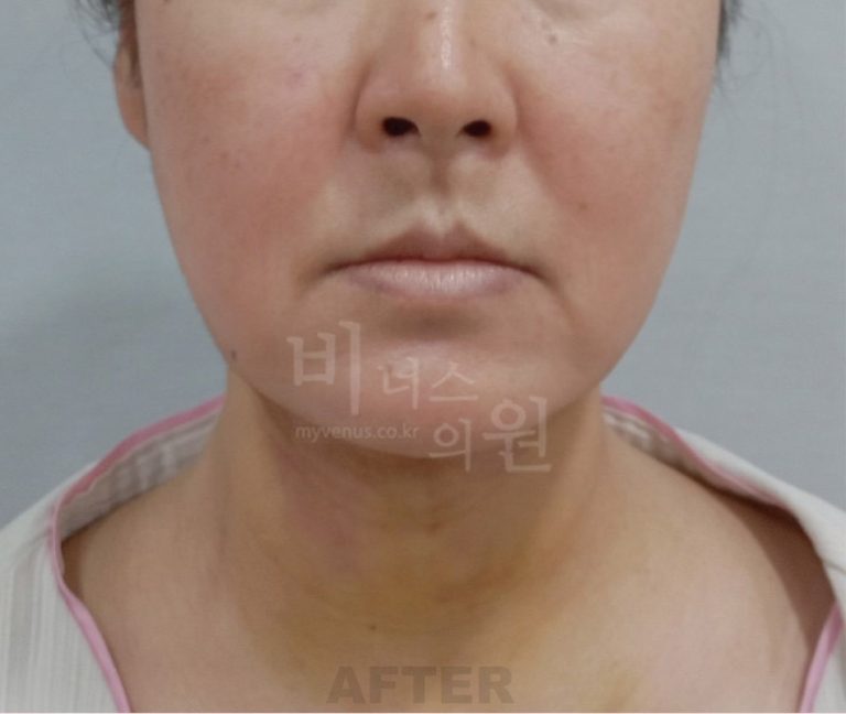 턱지방흡입 정면 수술 후 사진 - 비너스의원 2024년 촬영 동일인