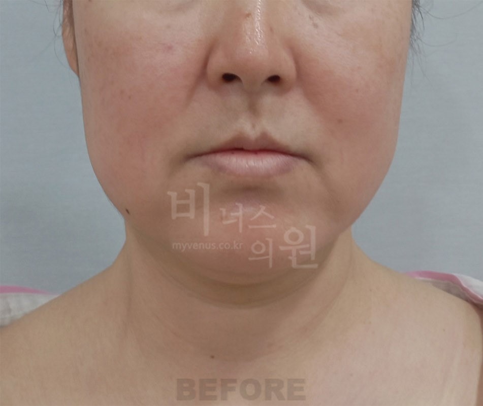 턱지방흡입 정면 수술 전 사진 - 비너스의원 2024년 촬영 동일인