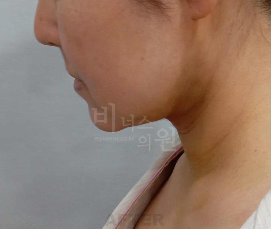 턱지방흡입 측면 ① 수술 후 사진 - 비너스의원 2024년 촬영 동일인