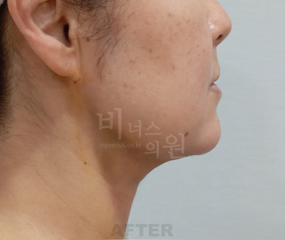 턱지방흡입 측면 ② 수술 후 사진 - 비너스의원 2024년 촬영 동일인