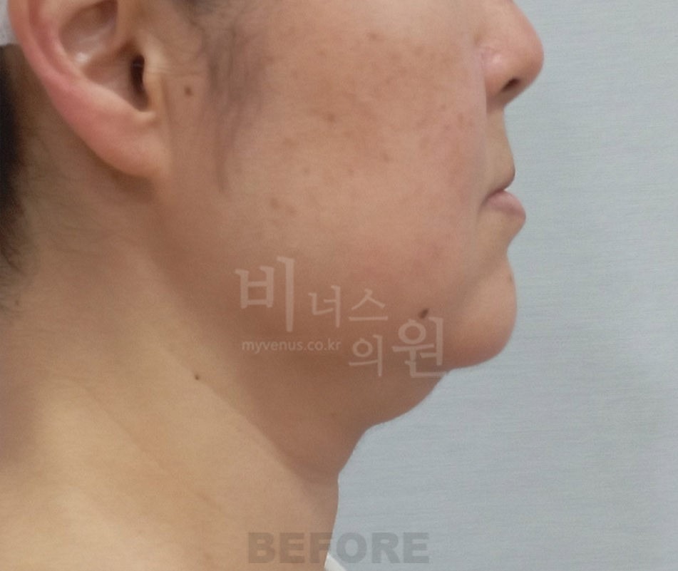 턱지방흡입 측면 ② 수술 전 사진 - 비너스의원 2024년 촬영 동일인