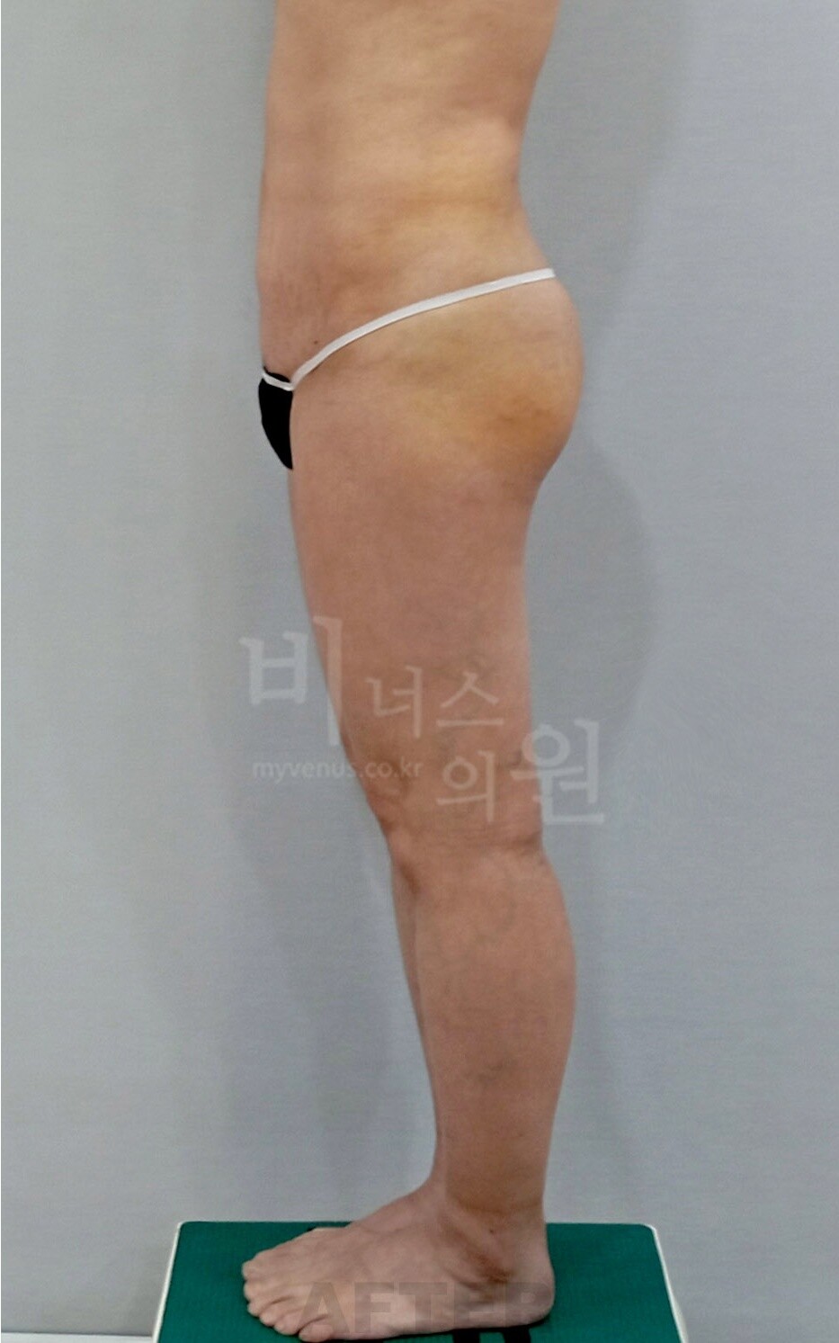 엉덩이 지방흡입 수술 후 좌측면 사진, 같은 자세에서 엉덩이 뒤쪽 돌출과 아래 윤곽