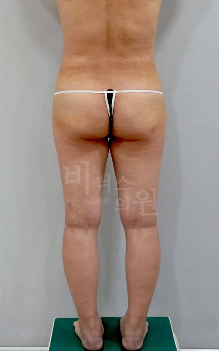 엉덩이축소 후 일상 복귀 캘린더 — 첫 주의 어지럼부터 6개월까지, 시점마다 몸이 보내는 신호와 챙겨 둘 것들