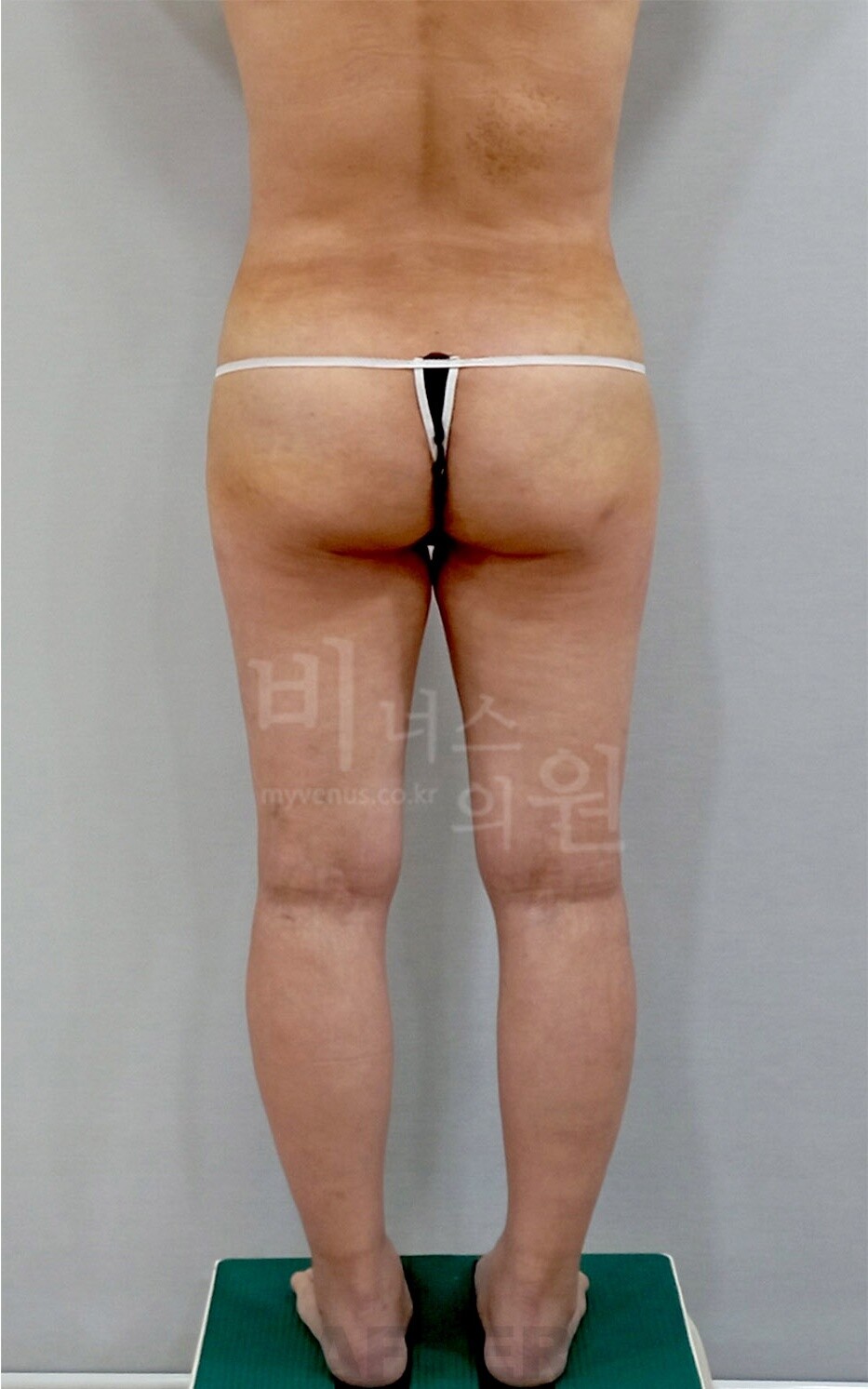 엉덩이 지방흡입 수술 후 후면 사진, 같은 자세에서 엉덩이 아래 윤곽과 허벅지로 이어지는 선