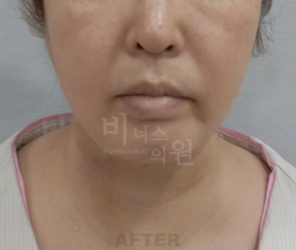 이중턱·턱 지방흡입 수술 후 정면 사진 — 턱 아래 윤곽이 정리된 모습(2024년 촬영)