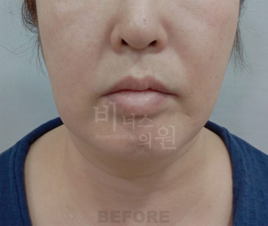 이중턱·턱 지방흡입 수술 전 정면 사진 — 턱 아래 볼륨이 겹쳐 보이는 모습(2024년 촬영)