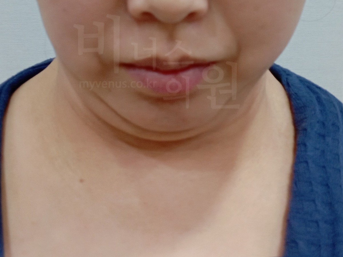 이중턱 지방흡입 수술 전 정면 (2024년 촬영)