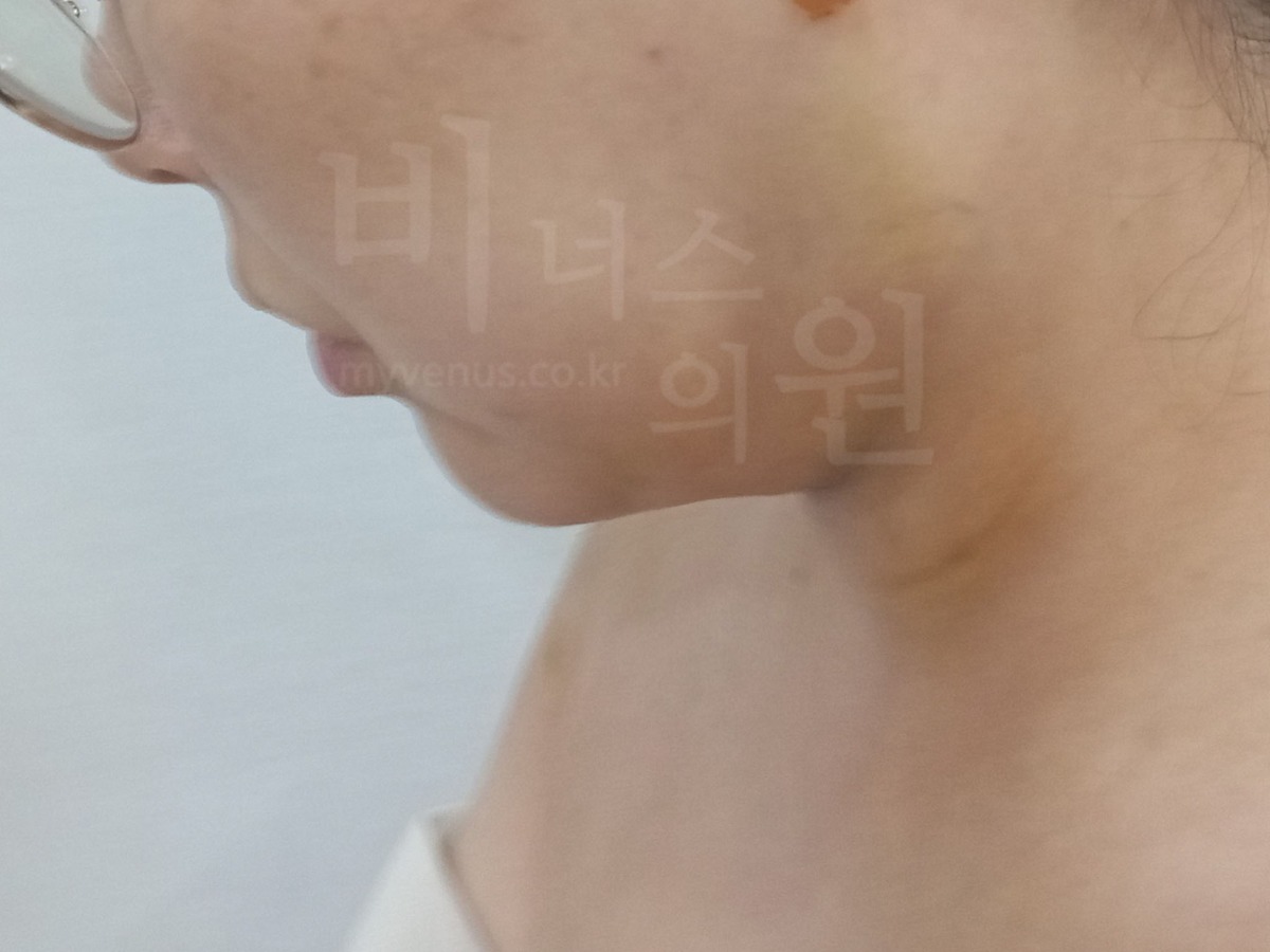 이중턱 지방흡입 수술 후 측면① (2024년 촬영)
