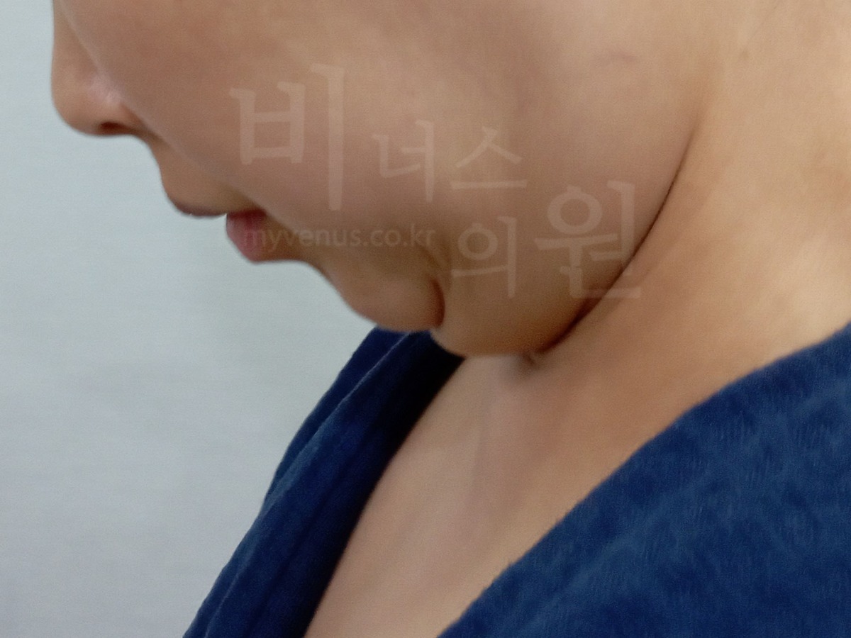이중턱 지방흡입 수술 전 측면① (2024년 촬영)